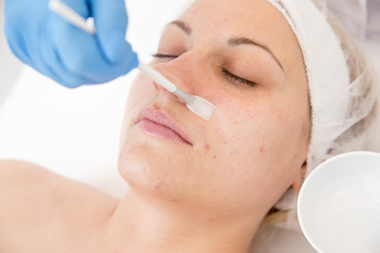 Acne Treatment BRAMPTON