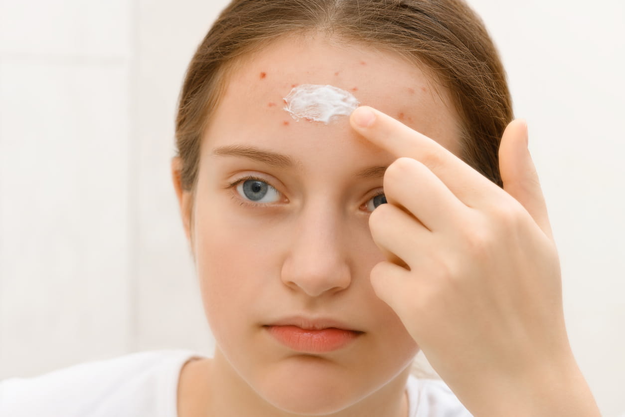 Acne Treatment BRAMPTON