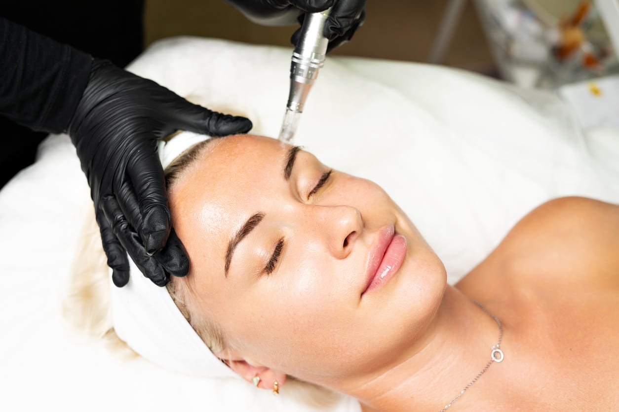 Dermastamp Micro-Needling Brampton