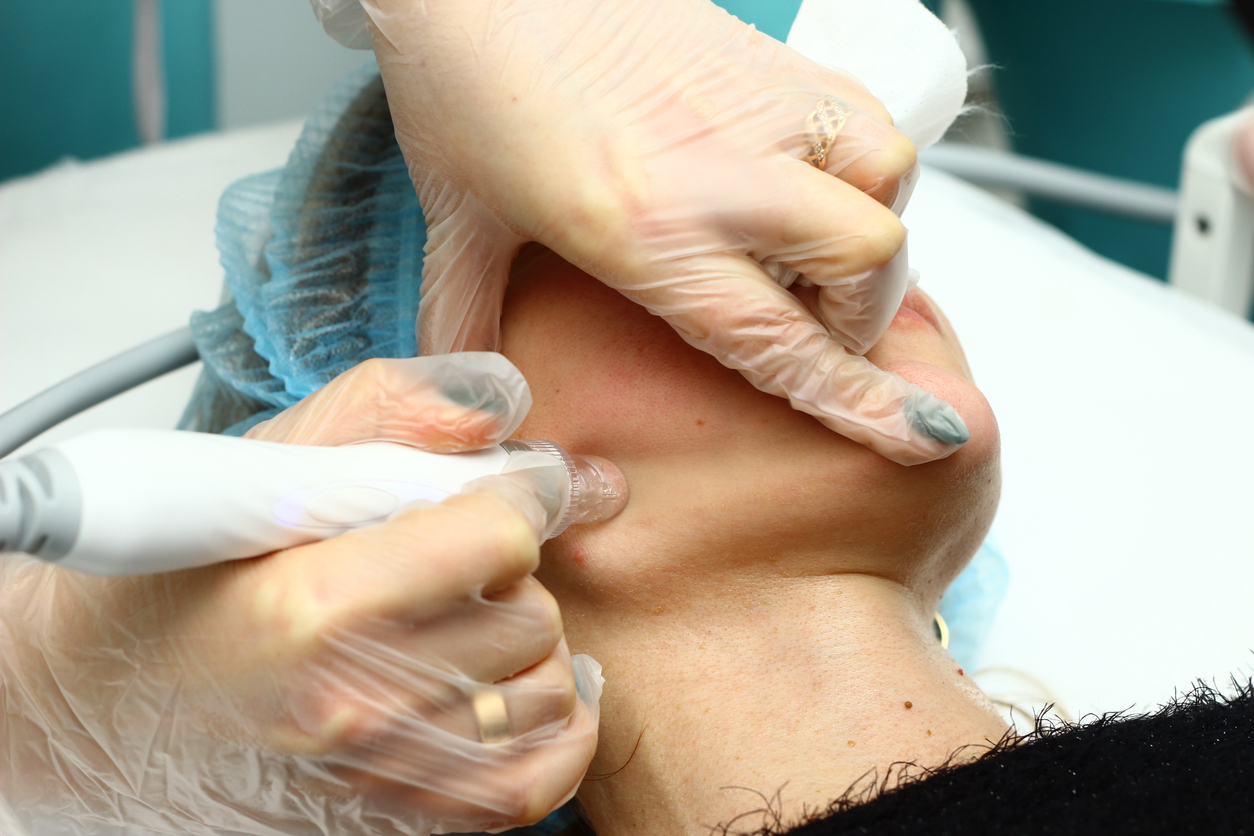 Dermastamp Microneedling