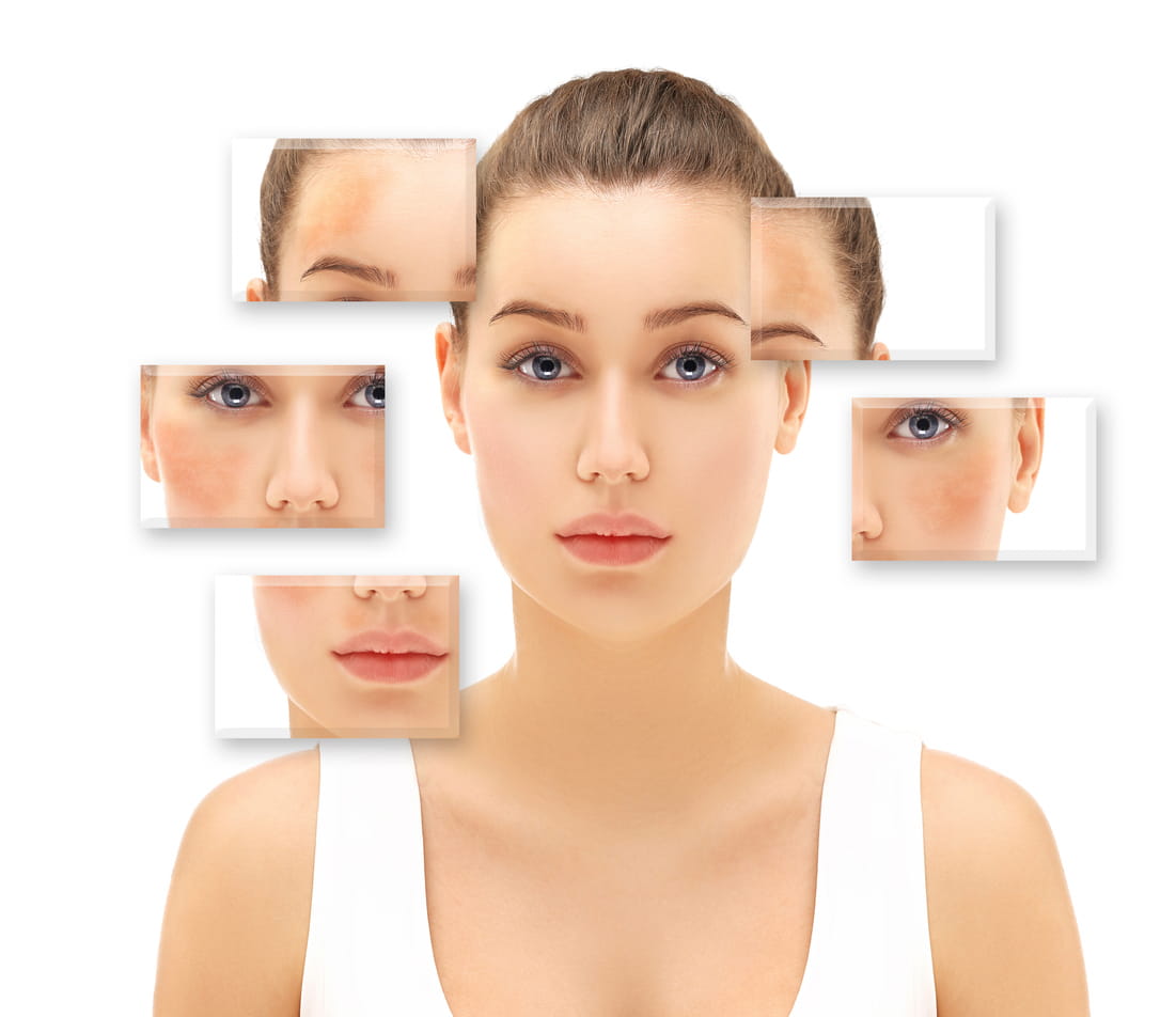 Melasma Pigmentation Treatment BRAMPTON