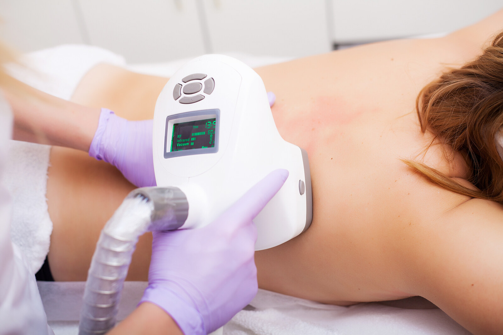 Back Laser Hair Removal in Brampton