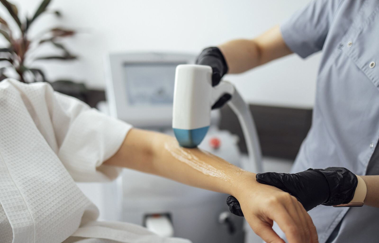Cheek Laser Hair Removal in Brampton