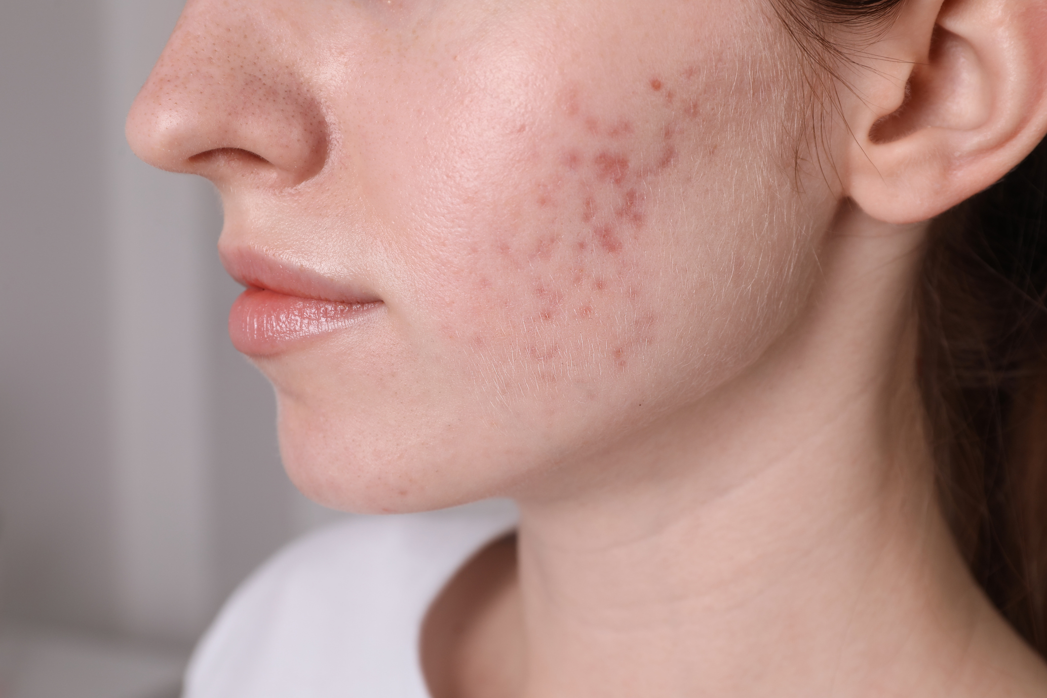 The Truth About Acne Scars: How Collagen Induction Levels Your Texture<br />

