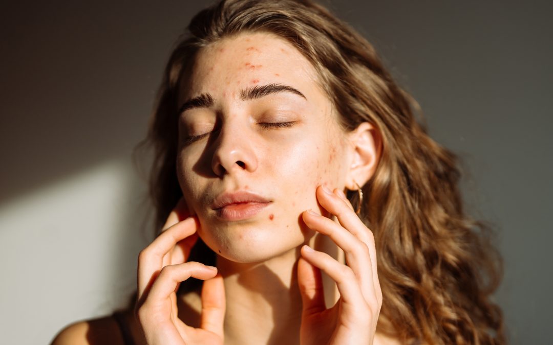 The Truth About Acne Scars: How Collagen Induction Levels Your Texture